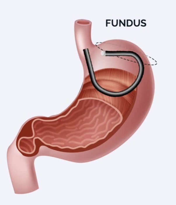 Diagram of the stomach with the fundus highlighted and an endoscope positioned for Gastric Fundal Mucosal Ablation