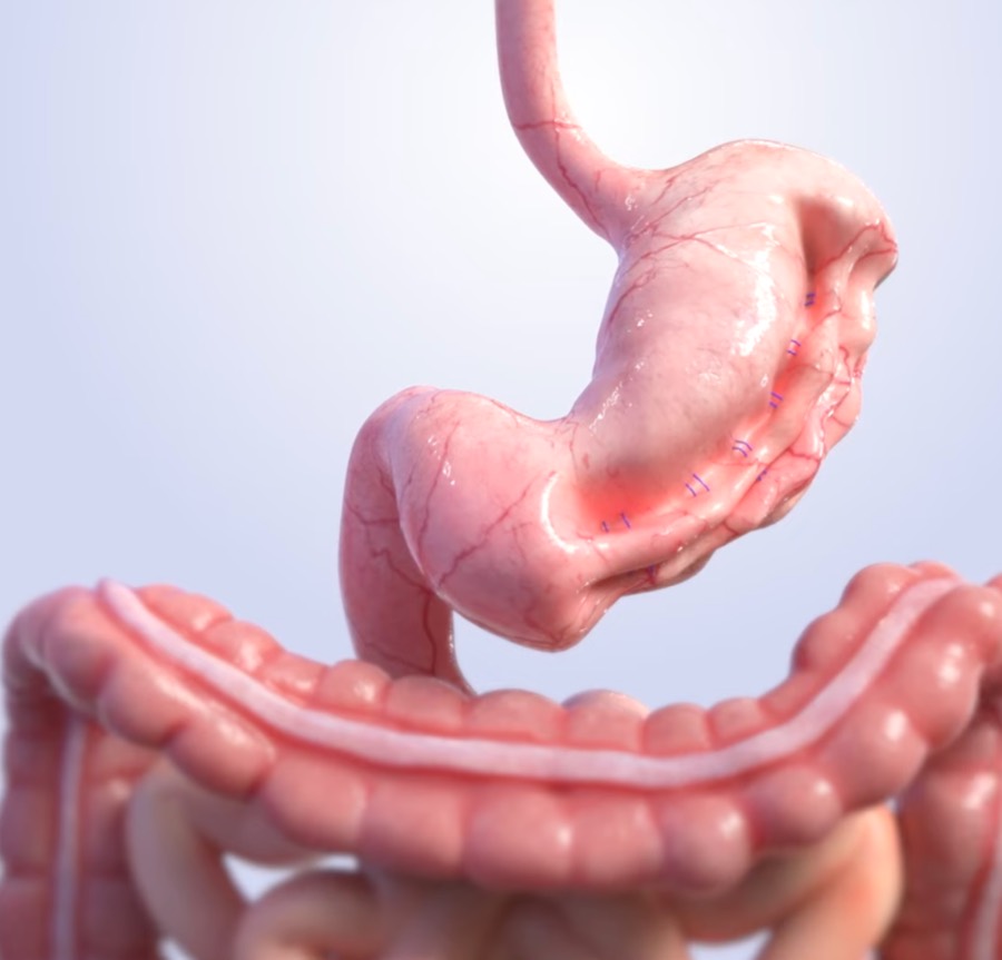 Stomach after Endoscopic Sleeve Gastroplasty, showing the internal sutures that create the sleeve shape
