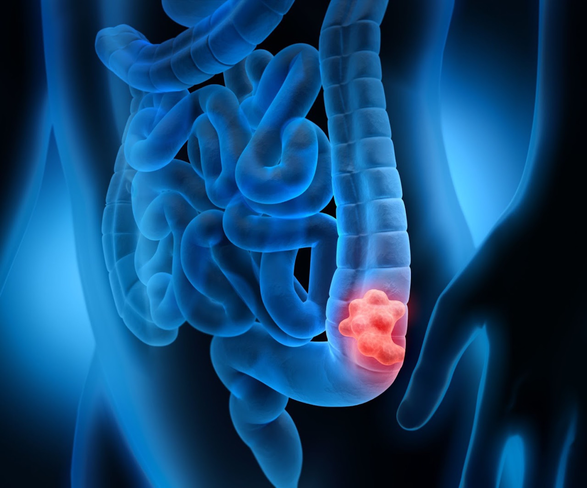 EMR / Polyp Removal